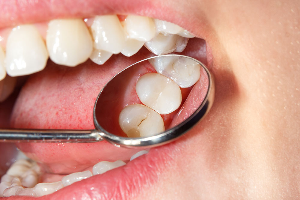 Why Choose Dental Sealants?